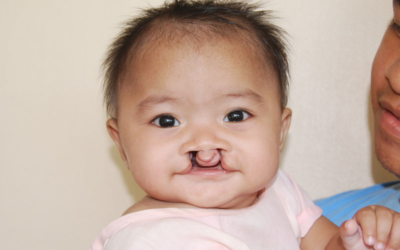 Bilateral cleft lip and palate